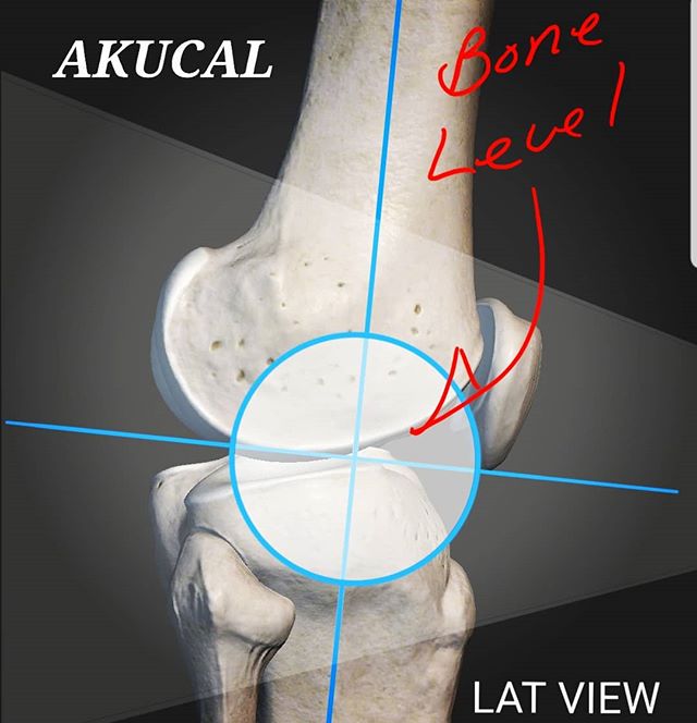 Scaling your x-ray begins with placement.  The center of the Akucal's marker is placed as closely as possible to bone level. That's the secret and we've made it effortless to do. Buy Akucals directly from the source at J2Medical. Try one until it pay