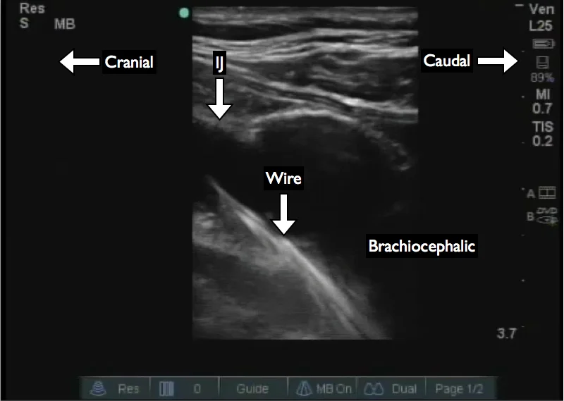 Figure 1: View of the wire in the brachiocephalic vein. This probe does not have a low enough frequency and maximal depth to adequately view the superior vena cava in this patient. The probe is placed lateral and posterior to the clavicular head of the sternocleidomastoid muscle and directed toward the contralateral nipple.