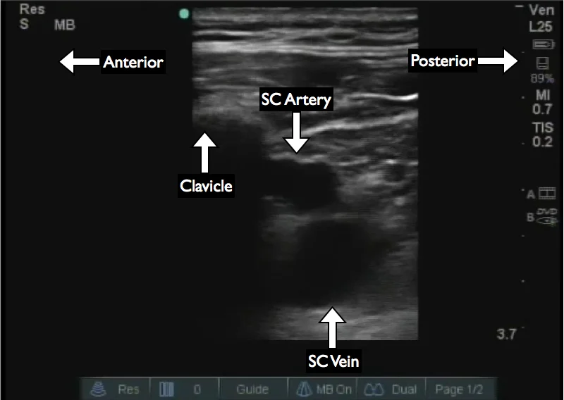 Figure 2: The subclavian artery and vein are visualized without wire present in the subclavian vein. The probe is placed superior the clavicle and lateral to the clavicular head of the sternocleidomastoid muscle.