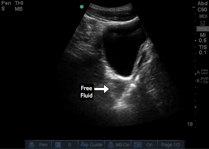 Sagittal view of the bladder with subtle free fluid. Although the far field gain is better than Figure 1, there are still echoes within the free fluid due to posterior acoustic enhancement. This highlights the need to be vigilant for subtle findings in the FAST exam.