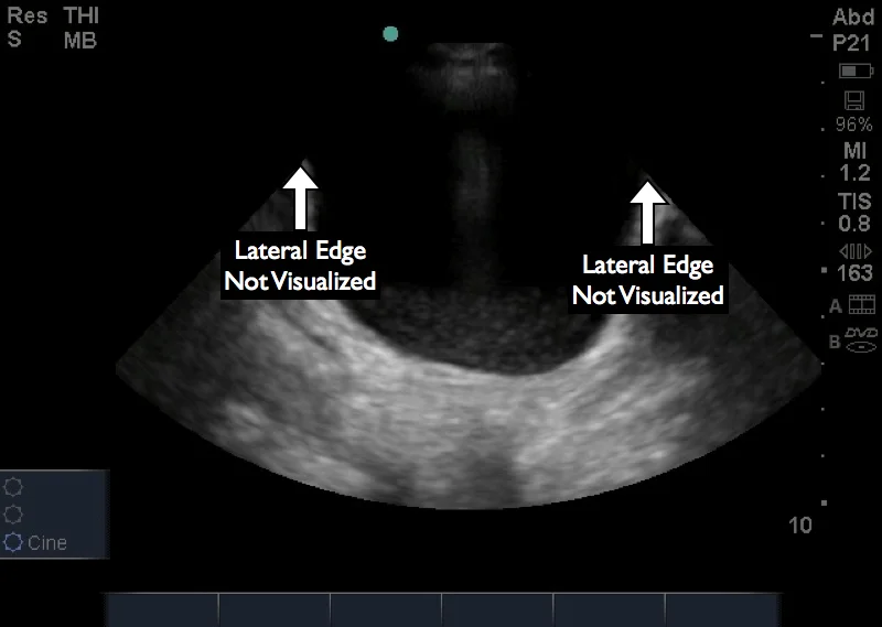 Transverse image of the bladder using a phased array transducer. Due to the small footprint, the lateral edges of the bladder are not visualized and free fluid may not be visualized.