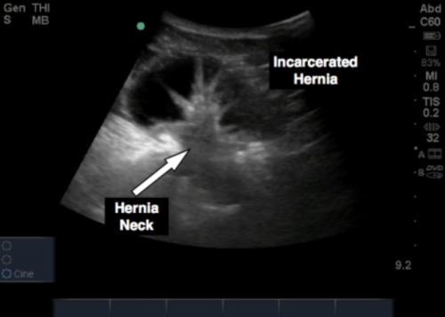 Figure 1: Incarcerated hernia with bowel and neck visualized