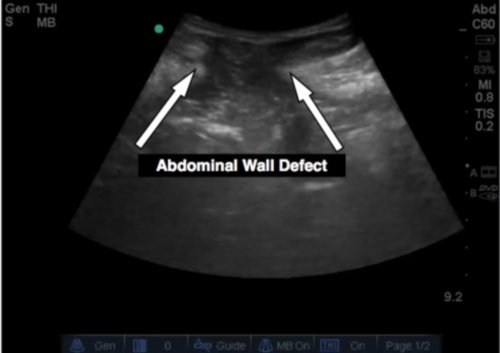 Figure 2: Post reductions fat containing hernia and neck are visualized