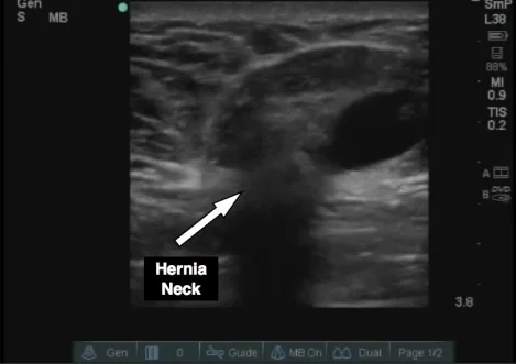 Figure 3: Small hernia lateral to the neck