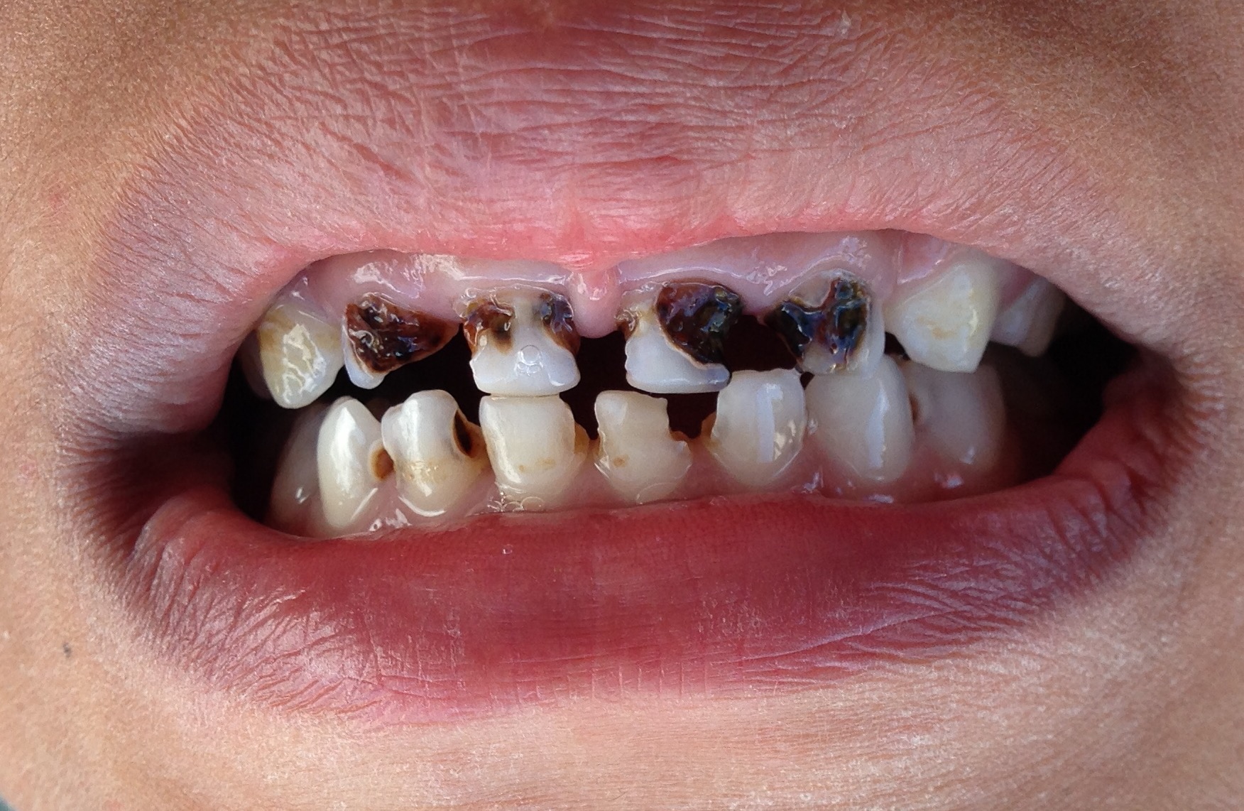 Select research on the links between sugar and tooth decay