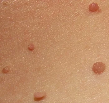 Multiple Skin-tags