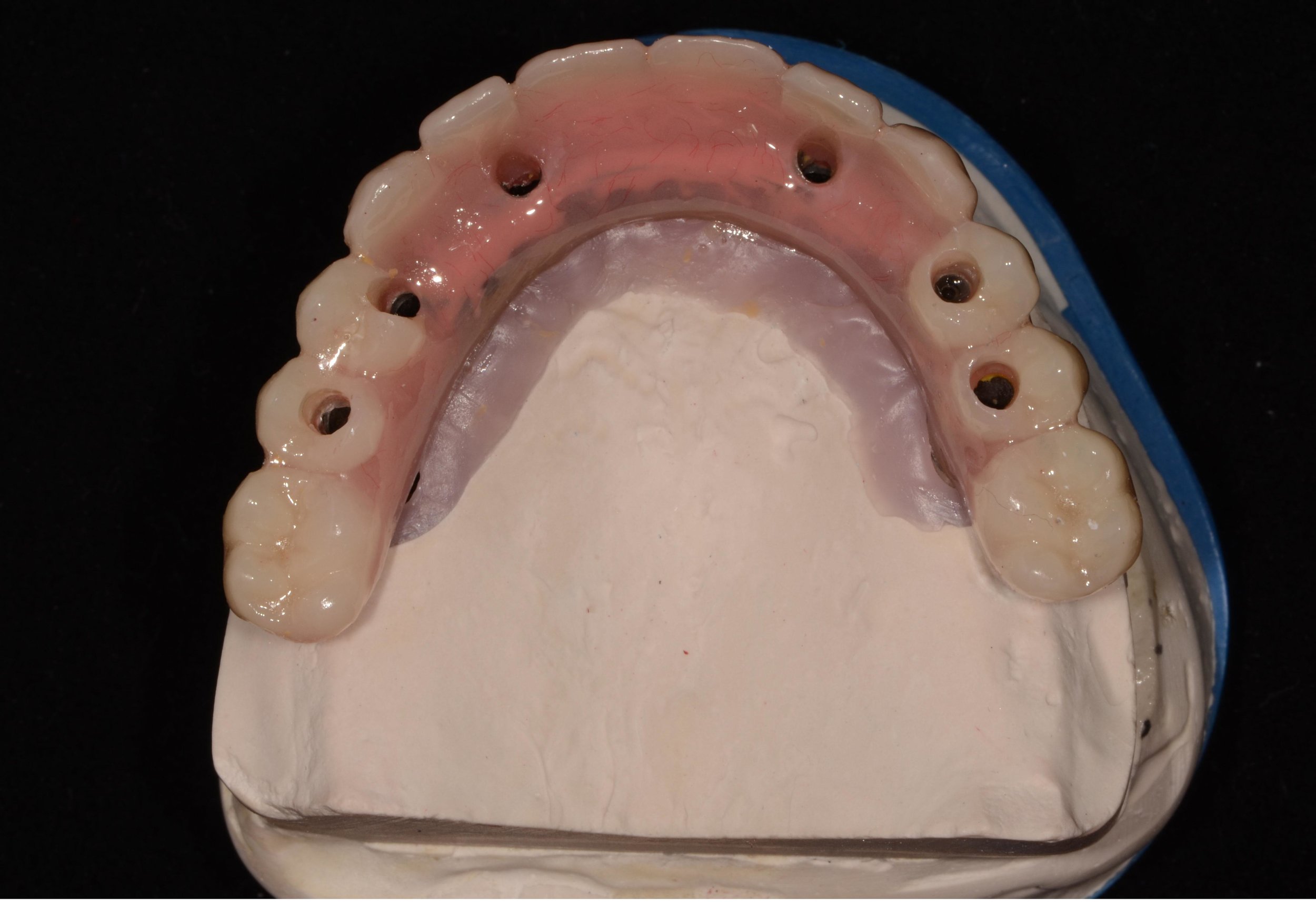 After Retreaded Hybrid Complete Upper/Lower Denture
