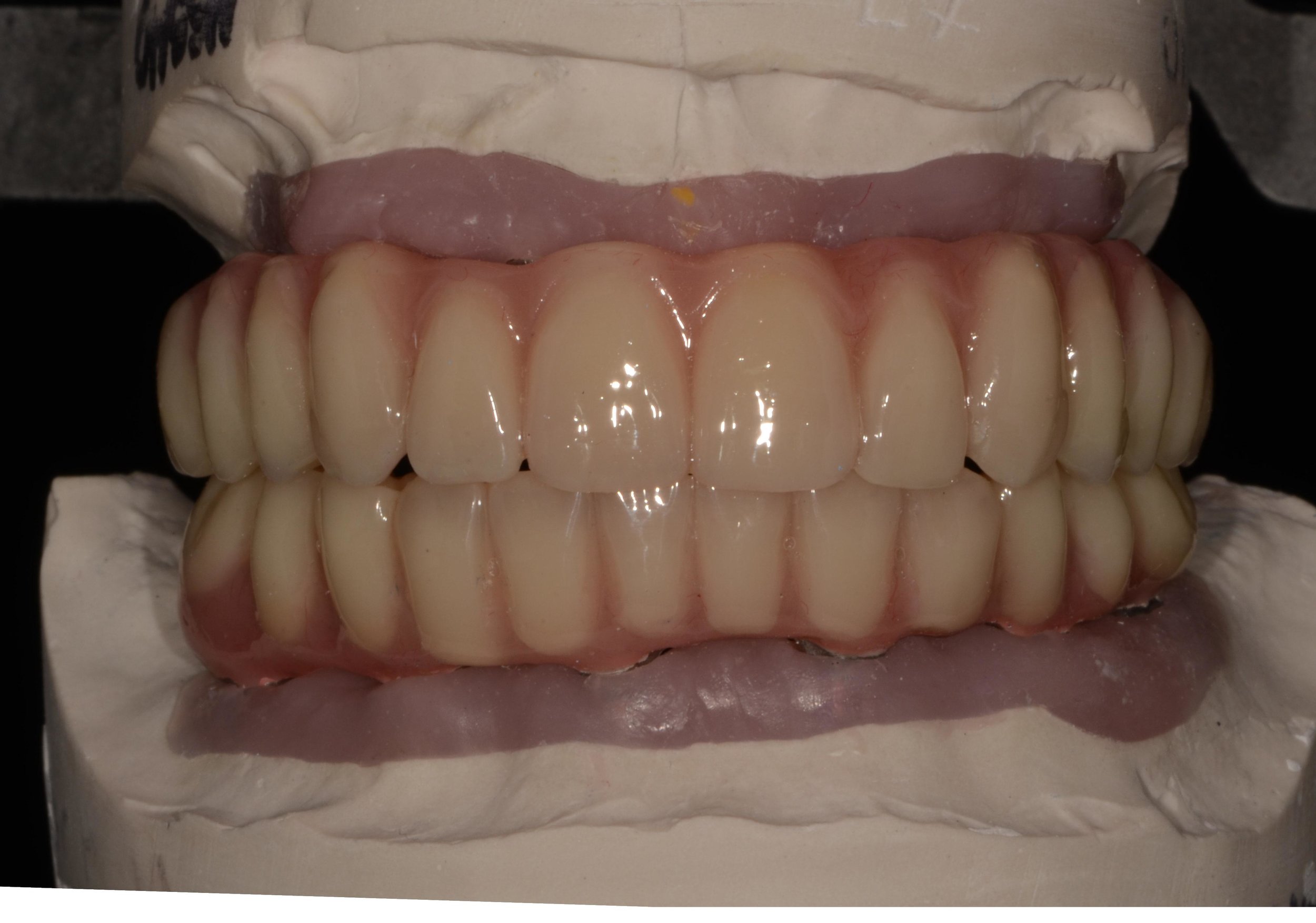After Retreaded Hybrid Complete Upper/Lower Denture