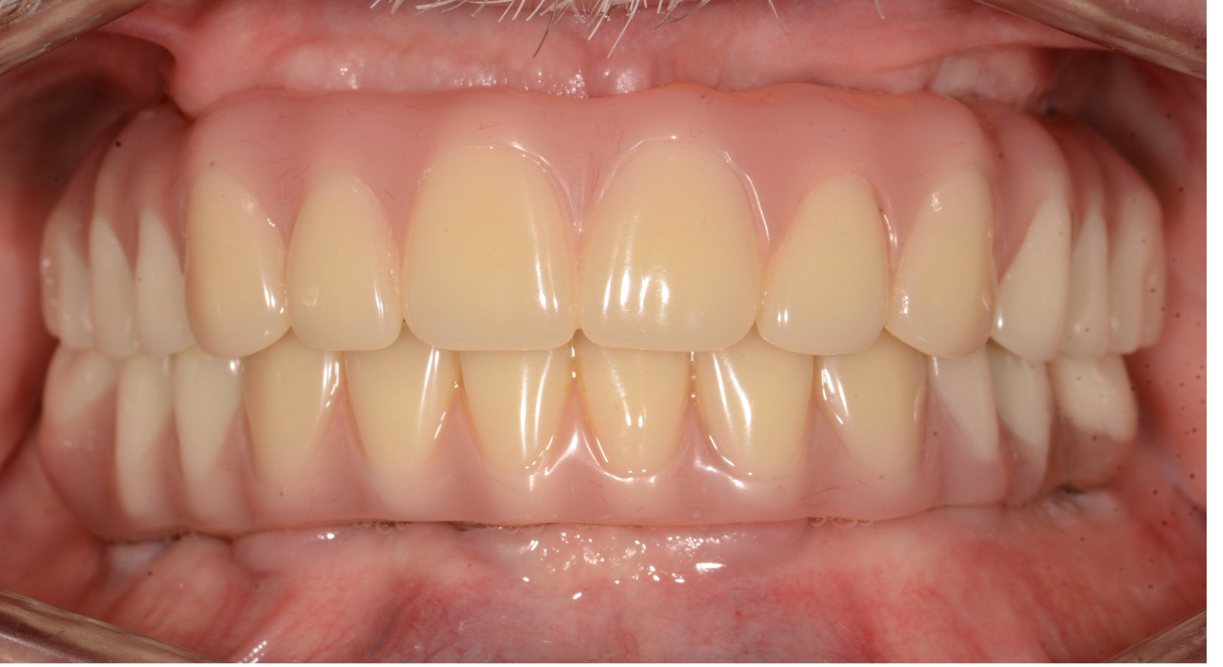5 Yrs Old Before Complete Upper/Lower Hybrid Denture