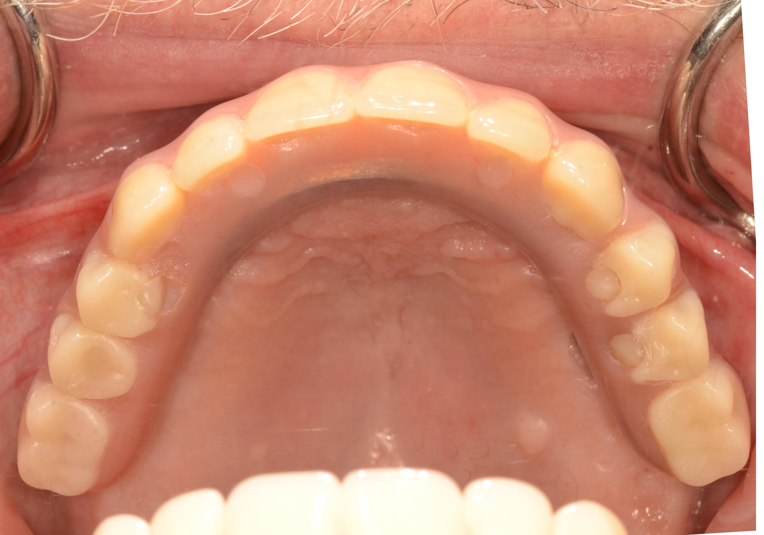 5 Yrs Old Before Complete Upper/Lower Hybrid Denture