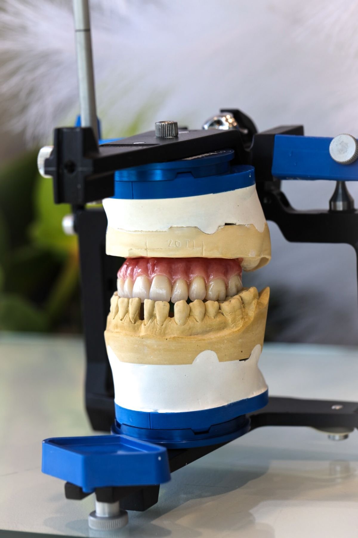 fixed-hybrid-dentures-06.jpg