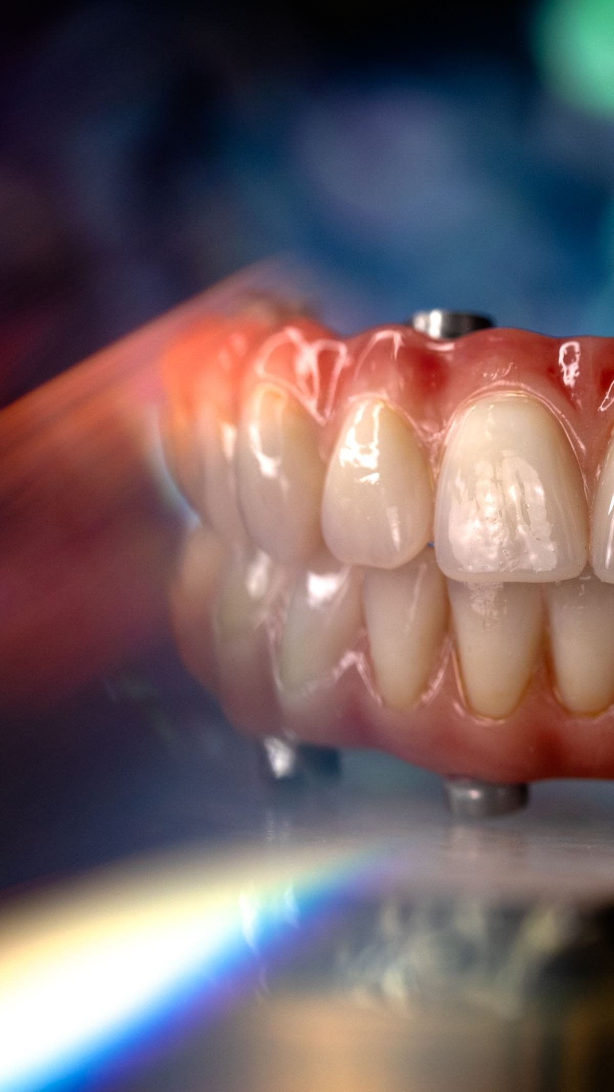 fixed-hybrid-dentures-09.jpg