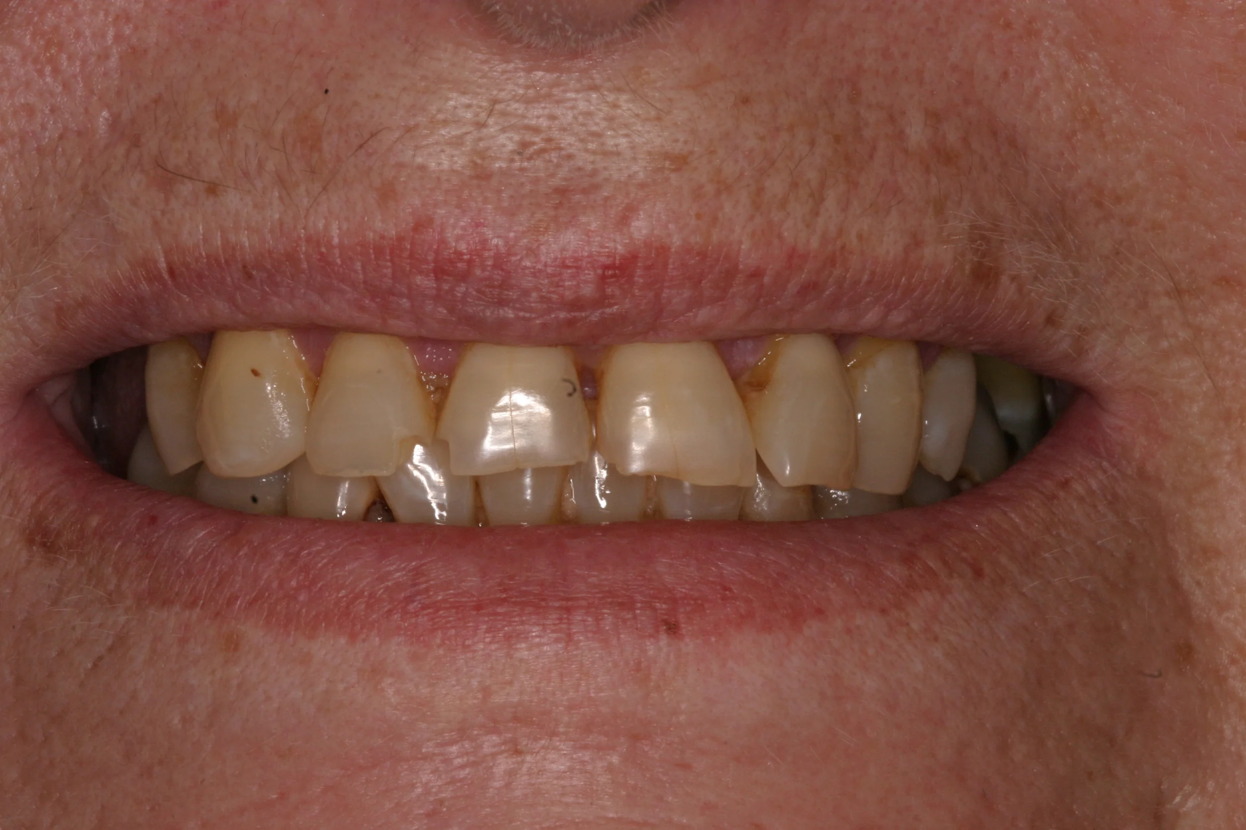 Before Treatment