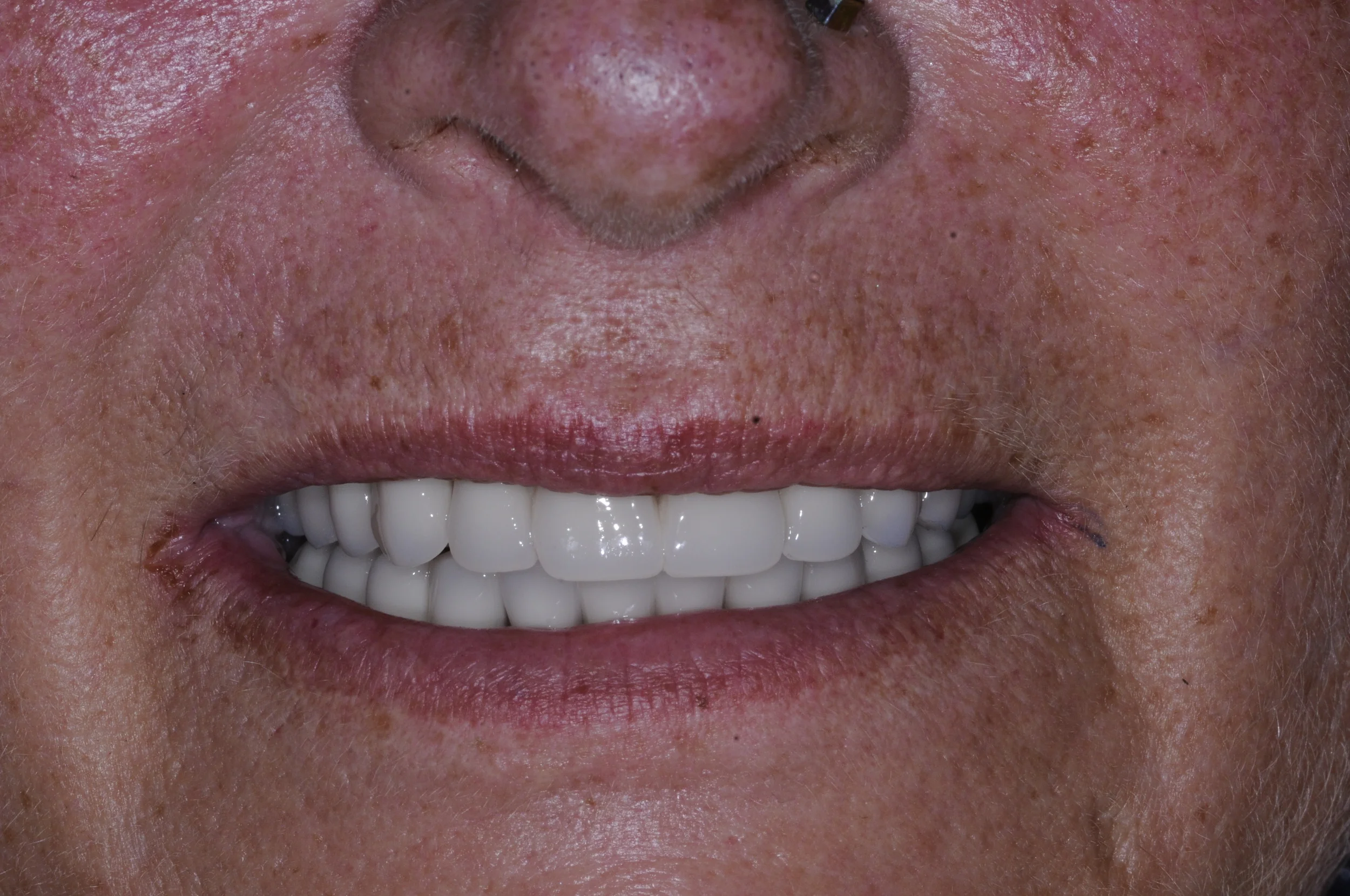 After Treatment