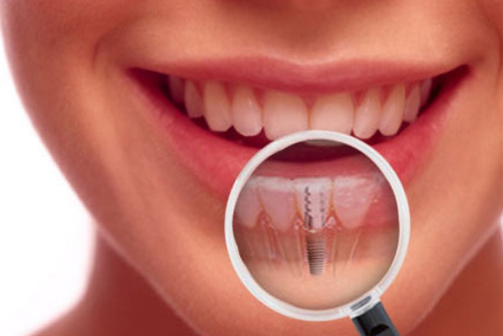 background_dental implants.jpg