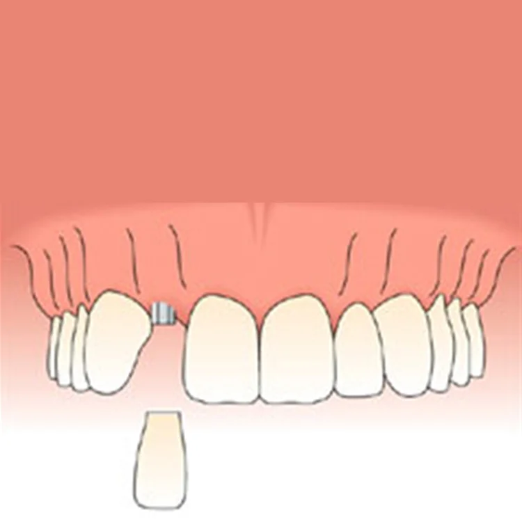 singletooth2.jpg