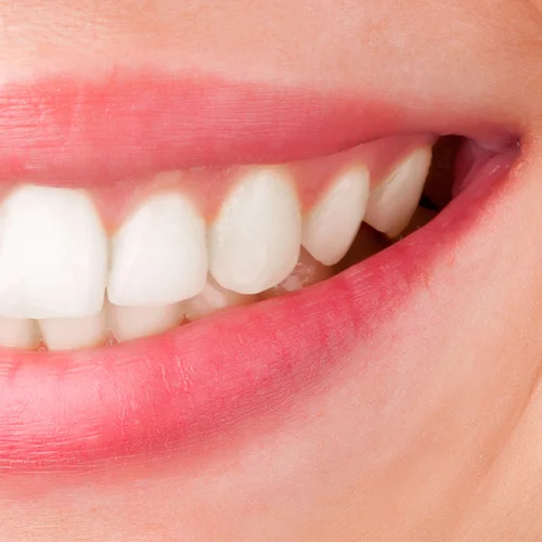 Dentist Teeth Whitening vs. Over the Counter Teeth Whitening