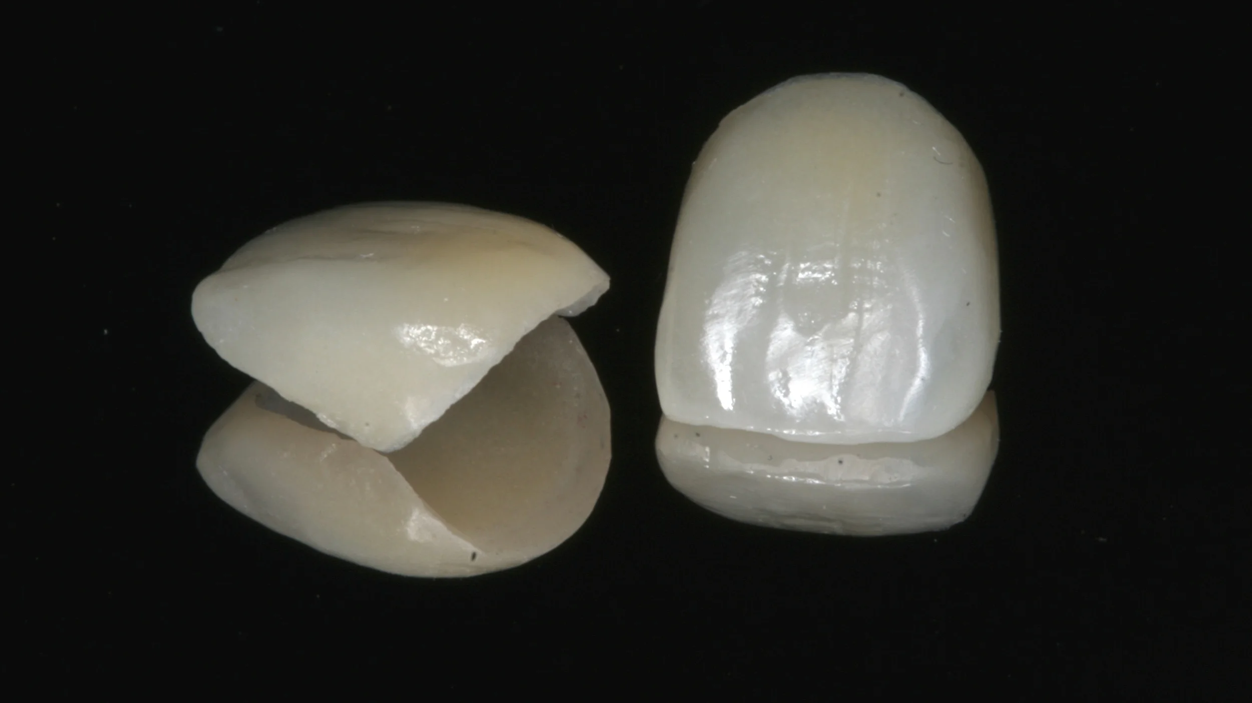 Composite Veneers or Porcelain Veneers: Which is Better?