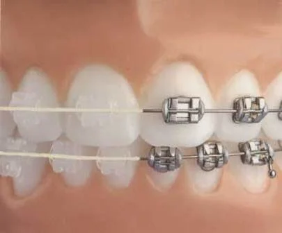Types of Braces