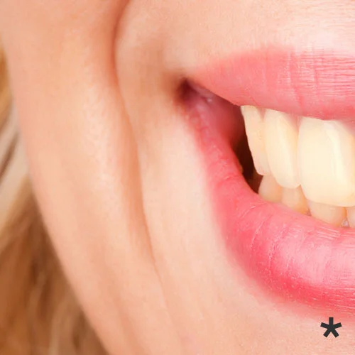 TeethWhiteningBefore