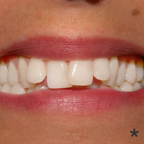 orthodontics before.jpg