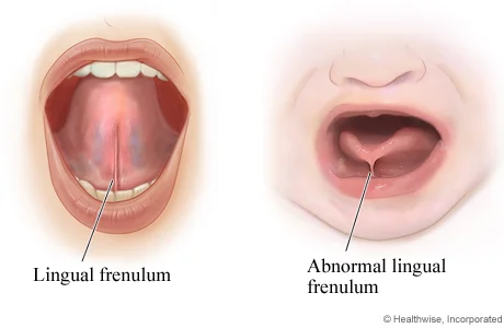 Tongue Ties Breastfeeding problems