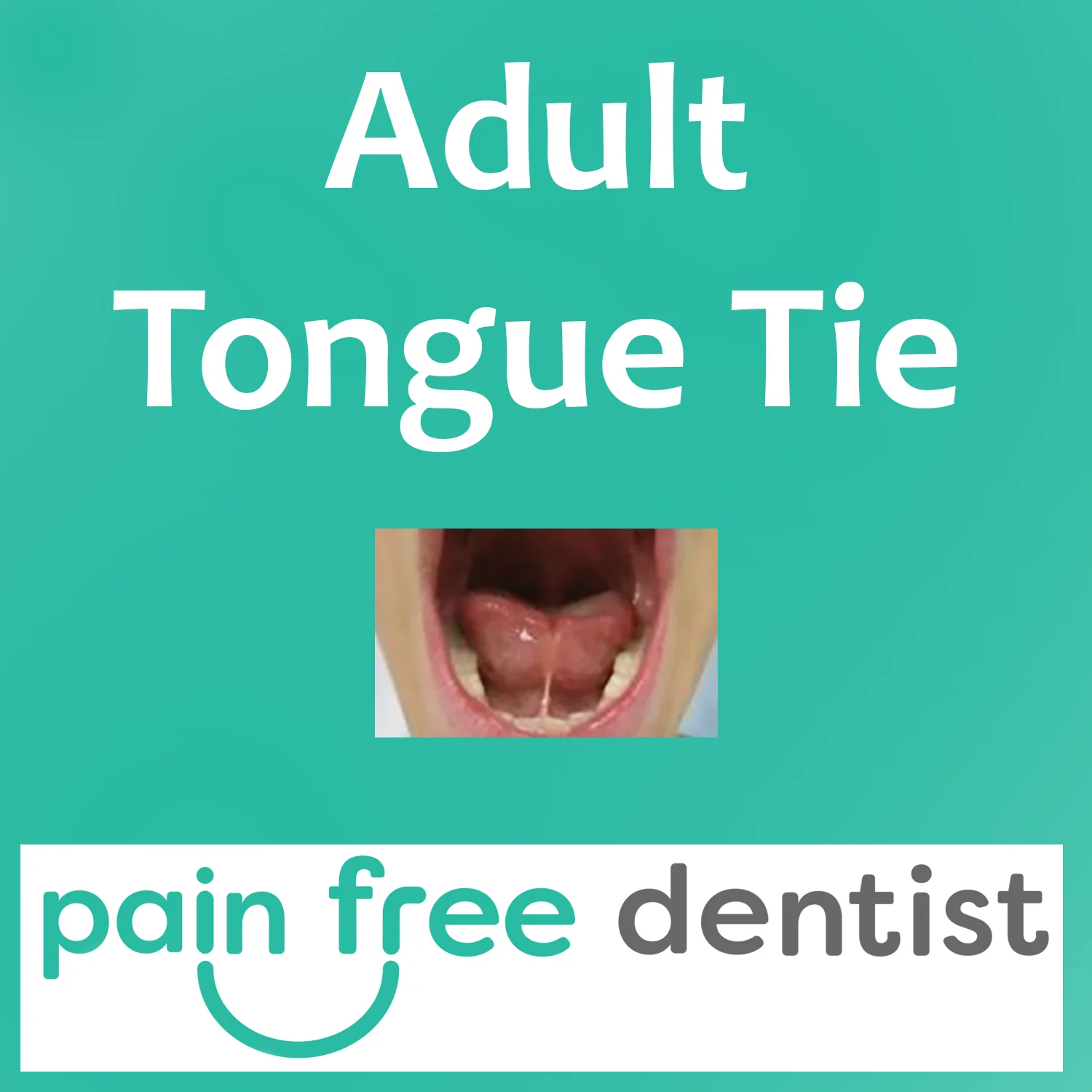 Adult Tongue Tie