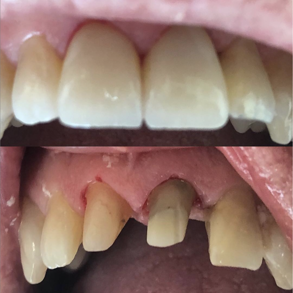 2 porcelain crowns for front teeth