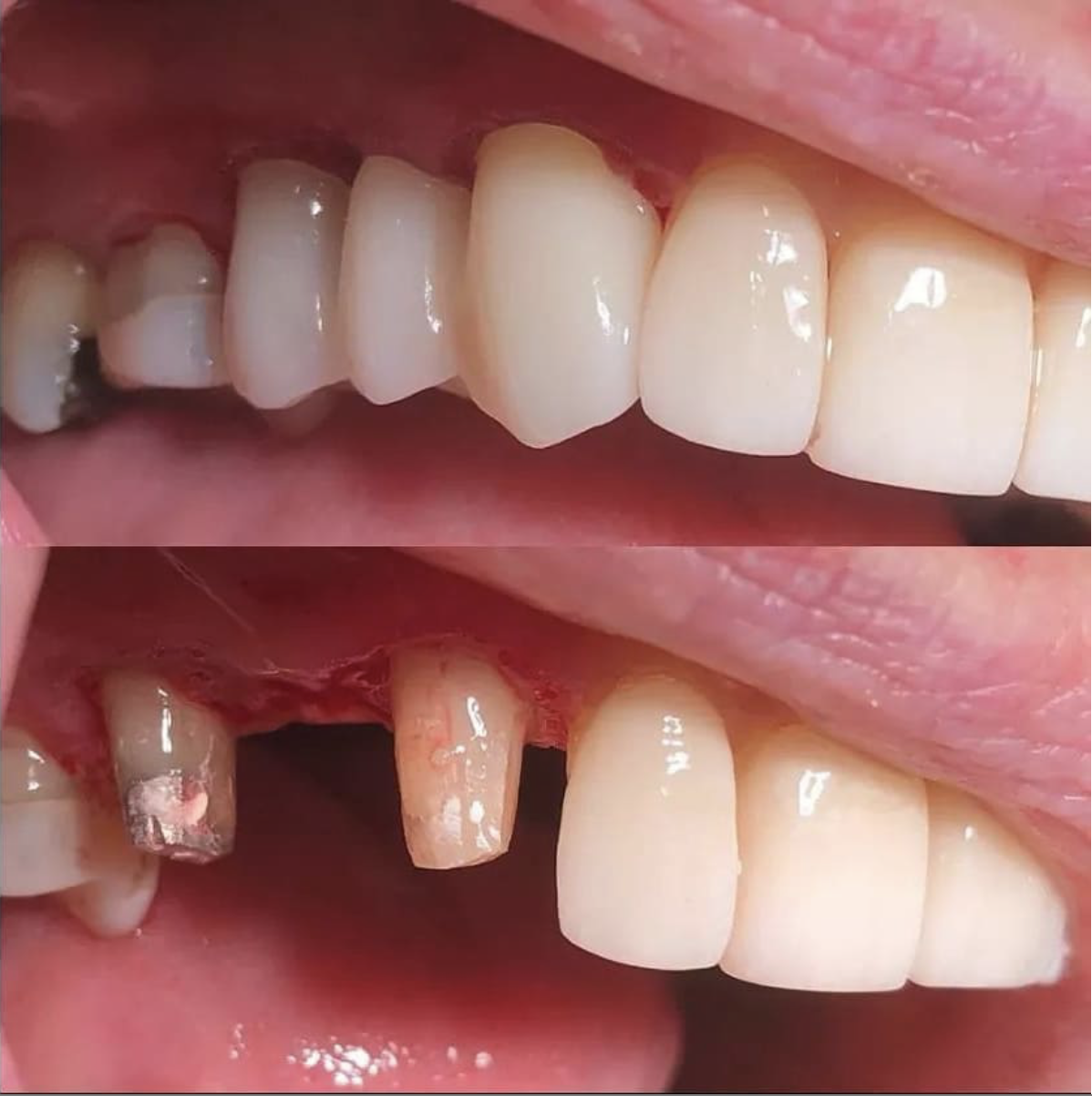 Porcelain dental bridge