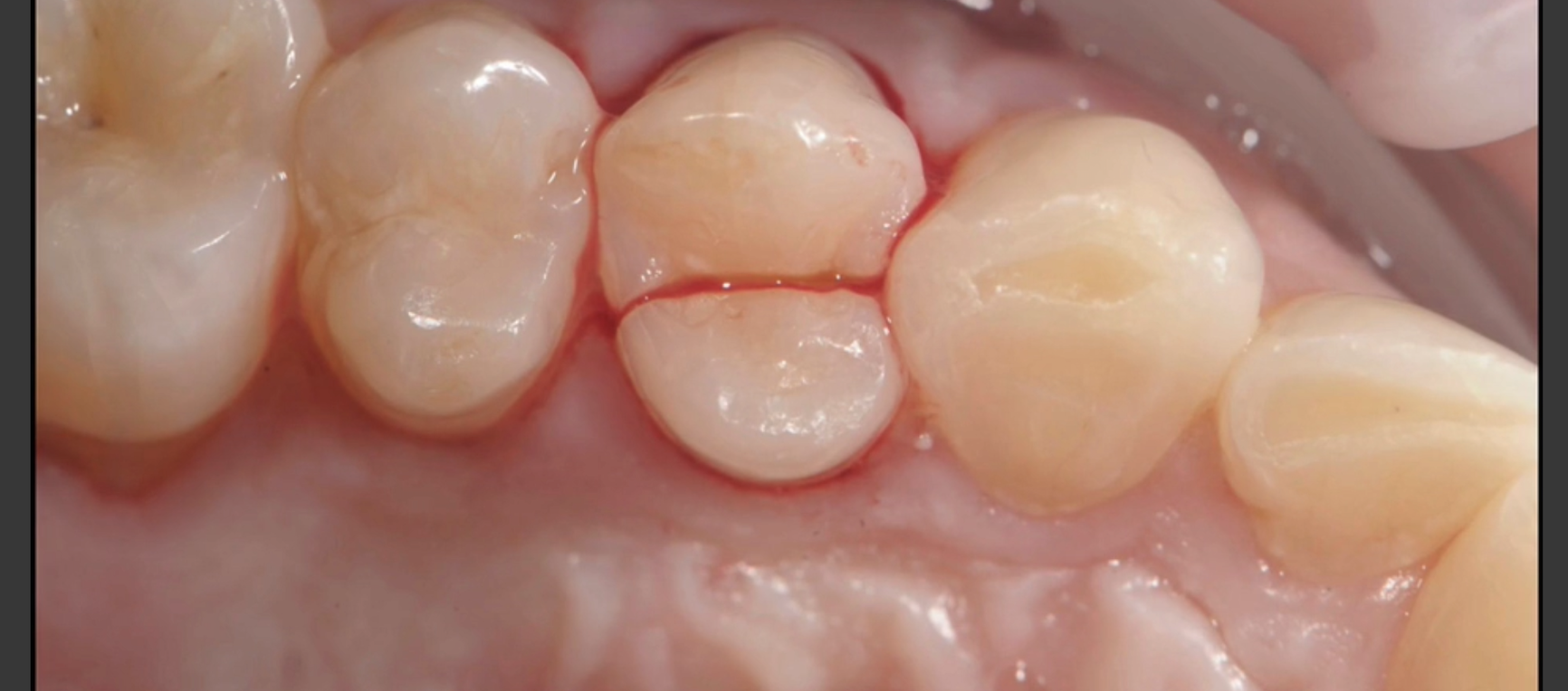 Broken cracked tooth