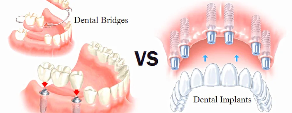Missing Tooth: Dental Bridge or Implants?