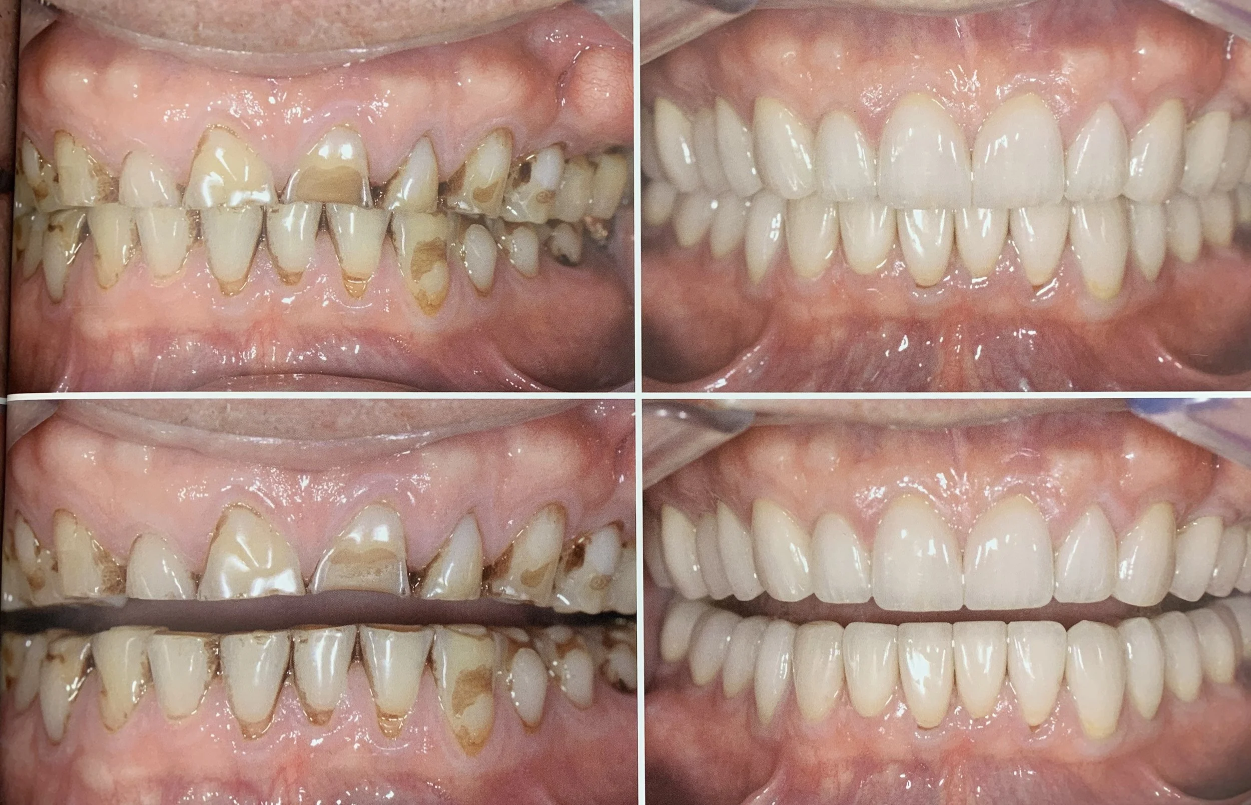 Worn Teeth Repair