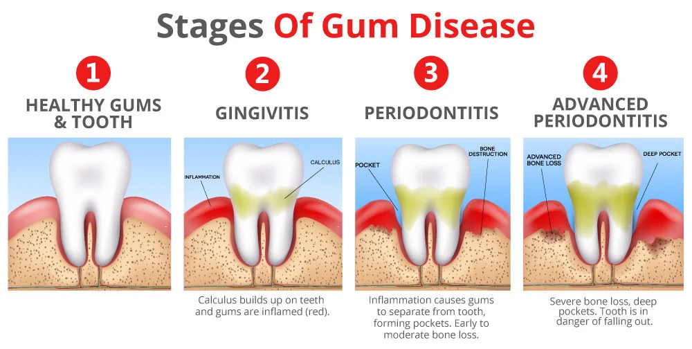 What is Gum Disease? How do it be prevented?