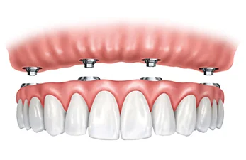 What is Dental Implant? Do I need it?