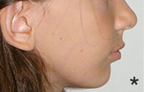 Functional-Jaw-Orthopedics-pain-free-dentist-Dulwich-hill-dental-sydney.jpg