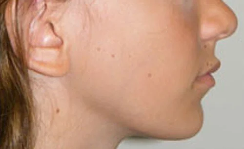 Functional-Jaw-Orthopedics-pain-free-dentist-Dulwich-hill-dental-sydney-02.jpg