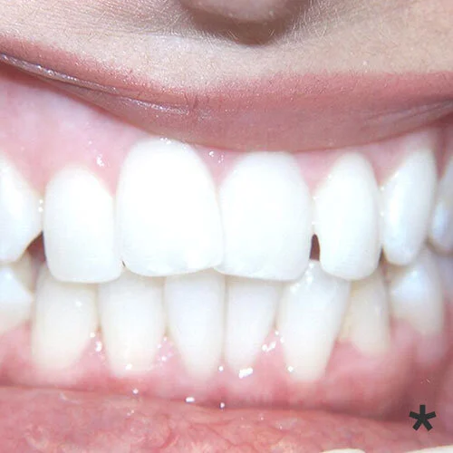 invisalign-pain-free-dentist-Dulwich-hill-dental-sydney.jpg
