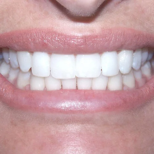 invisalign-pain-free-dentist-Dulwich-hill-dental-sydney-02.jpg