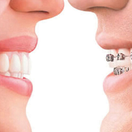 invisalign-pain-free-dentist-Dulwich-hill-dental-sydney-03.jpg