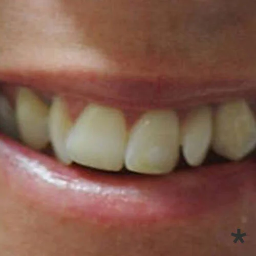 fast-braces-free-dentist-Dulwich-hill-dental-sydney.jpg