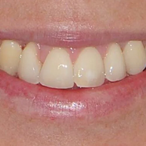 fast-braces-free-dentist-Dulwich-hill-dental-sydney-2.jpg