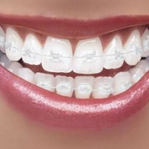 fast-braces-free-dentist-Dulwich-hill-dental-sydney-3.jpg