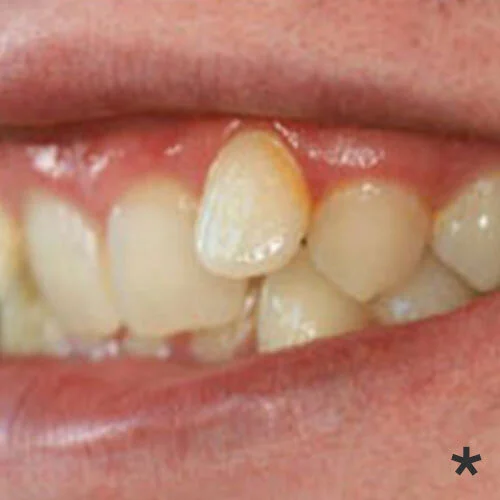 Clear-Braces-free-dentist-Dulwich-hill-dental-sydney.jpg