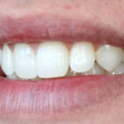 Clear-Braces-free-dentist-Dulwich-hill-dental-sydney-2.jpg