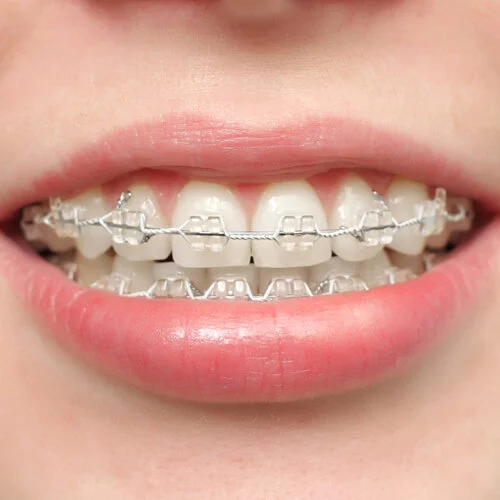 Clear-Braces-free-dentist-Dulwich-hill-dental-sydney-3.jpg