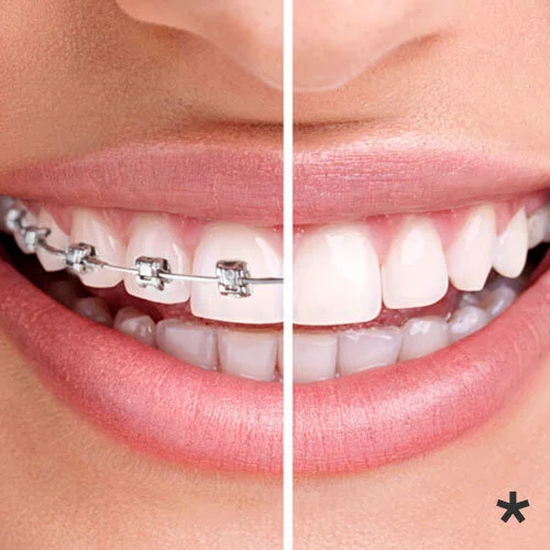 Lingual-braces-sydney-1.jpg