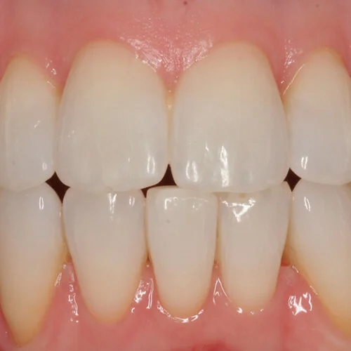 Lingual-braces-sydney-2.jpg