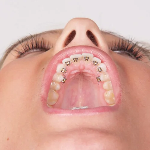 Lingual-braces-sydney-3.jpg
