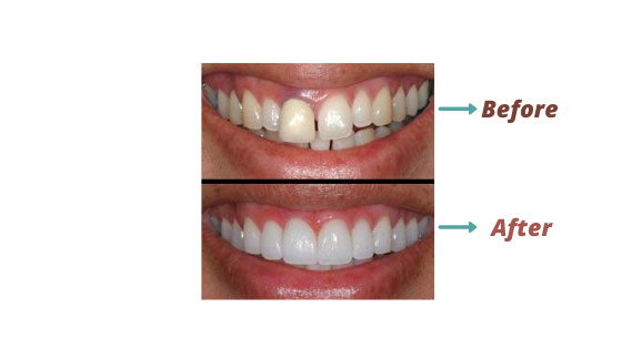 Dental Veneers- Pain free dentist Sydney