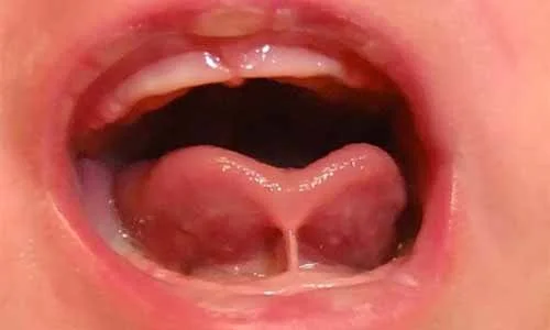 Tongue-Tie